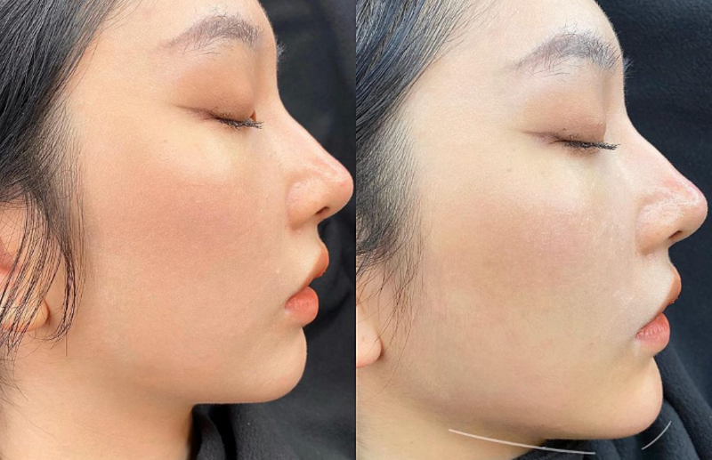 Thông thường, cằm sau tiêm filler cần khoảng 7–14 ngày để giảm sưng và ổn định dáng rõ hơn. 
