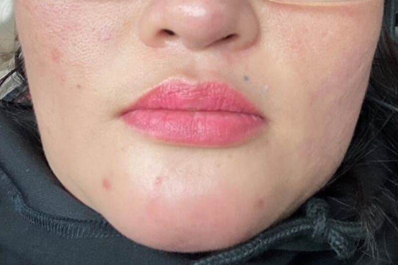 Trong vài ngày đầu, cằm có thể hơi sưng, căng hoặc chưa cân đối do filler và mô mềm chưa ổn định hoàn toàn. 