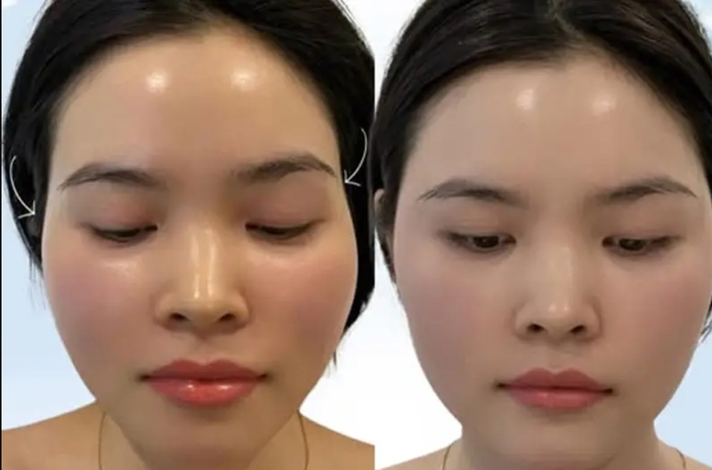 Dáng cằm sau tiêm filler thường thay đổi theo từng giai đoạn, từ sưng nhẹ ban đầu đến ổn định tự nhiên hơn. 