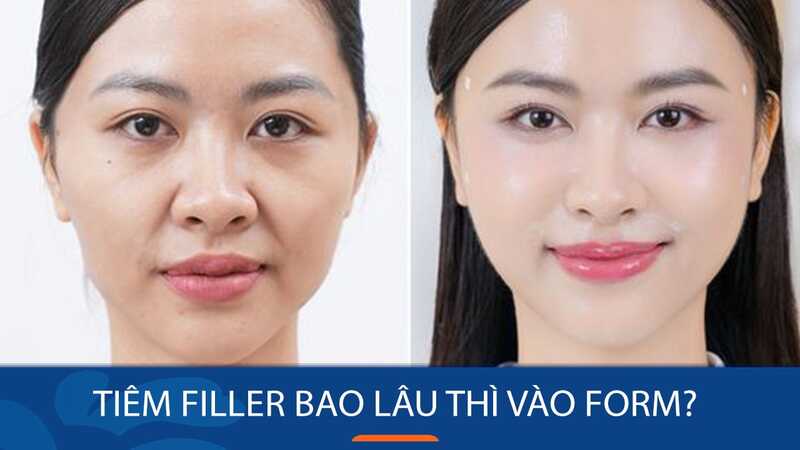 Cằm vào form đẹp thường có dáng hài hòa, giảm sưng rõ, không đau bất thường và biểu cảm tự nhiên hơn. 