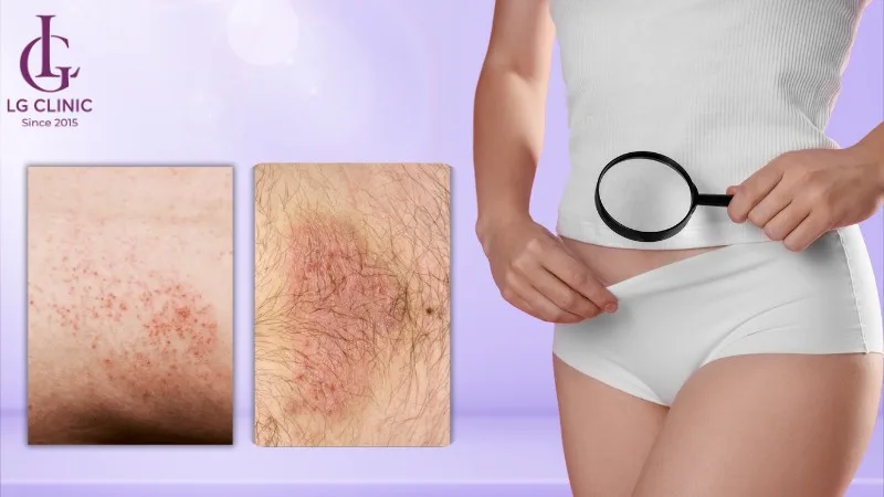 Các lỗi như cạo khô, dùng dao cũ hoặc wax khi da đang viêm có thể khiến vùng da dễ kích ứng hơn.